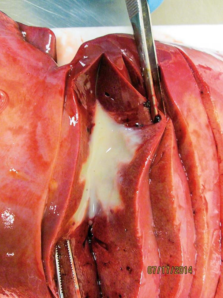 Liver abscess